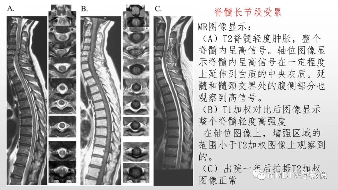 影像PPT - 【PPT】神经白塞病NBD-40