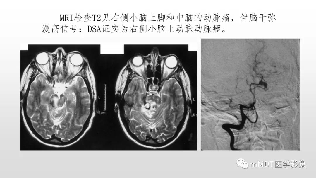 影像PPT - 【PPT】神经白塞病NBD-42
