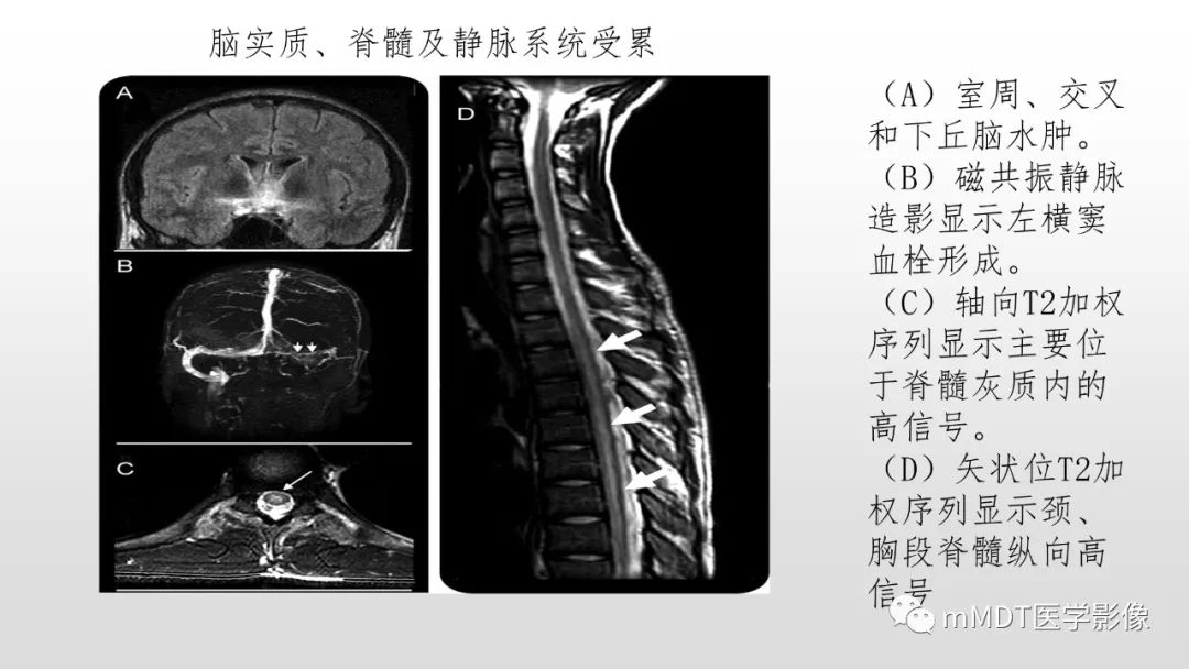 影像PPT - 【PPT】神经白塞病NBD-43