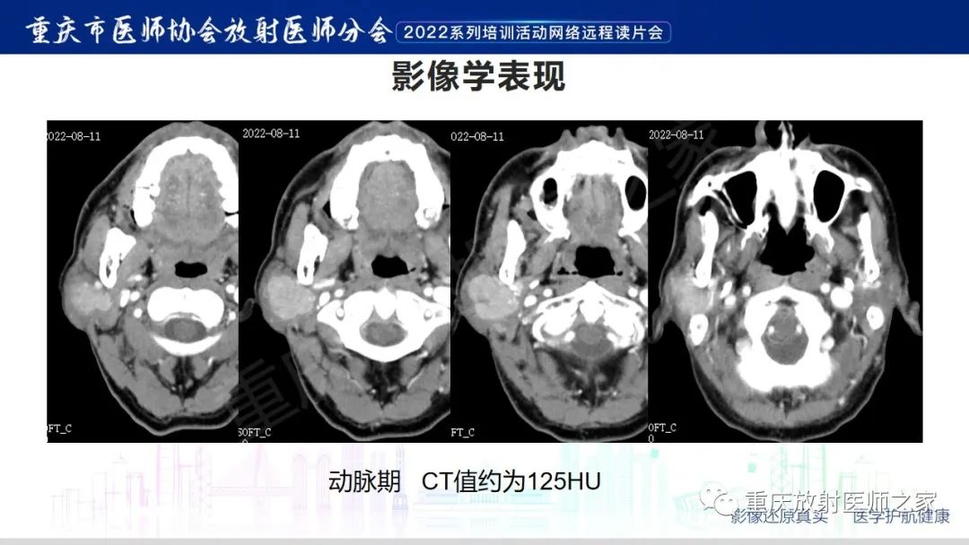 影像PPT - 【病例】腮腺腺淋巴瘤1例CT影像-4