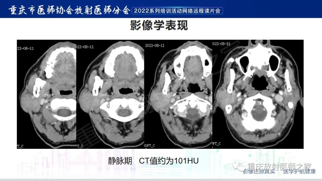 影像PPT - 【病例】腮腺腺淋巴瘤1例CT影像-5