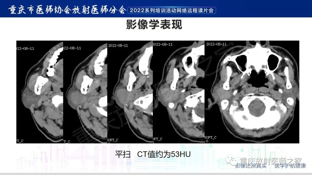 影像PPT - 【病例】腮腺腺淋巴瘤1例CT影像-3