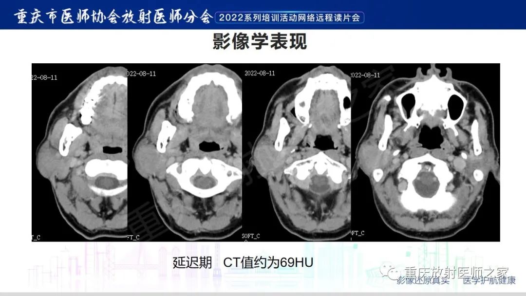 影像PPT - 【病例】腮腺腺淋巴瘤1例CT影像-6