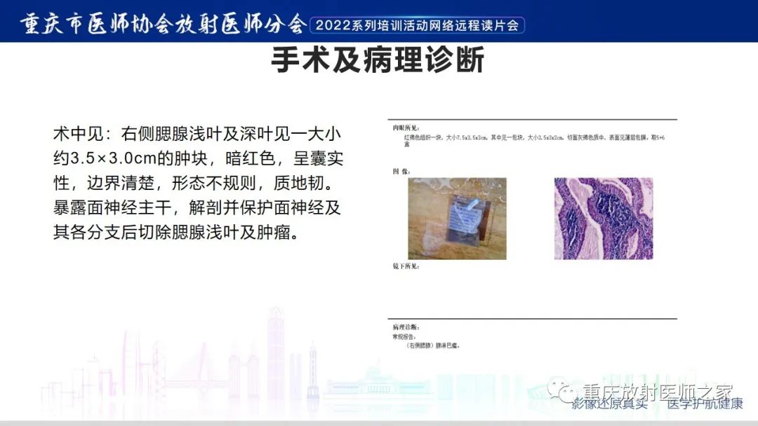 影像PPT - 【病例】腮腺腺淋巴瘤1例CT影像-8