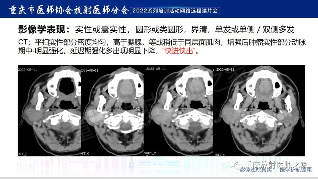 影像PPT - 【病例】腮腺腺淋巴瘤1例CT影像-10