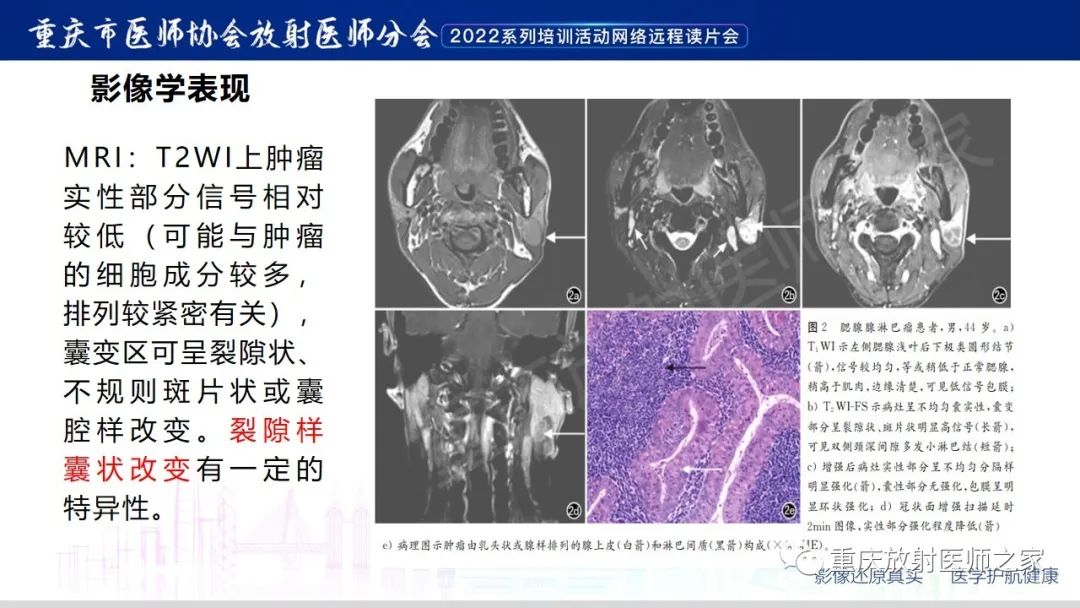 影像PPT - 【病例】腮腺腺淋巴瘤1例CT影像-11