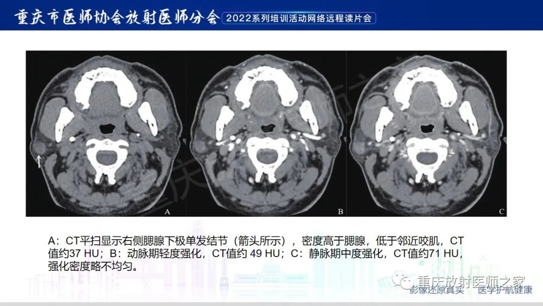 影像PPT - 【病例】腮腺腺淋巴瘤1例CT影像-14