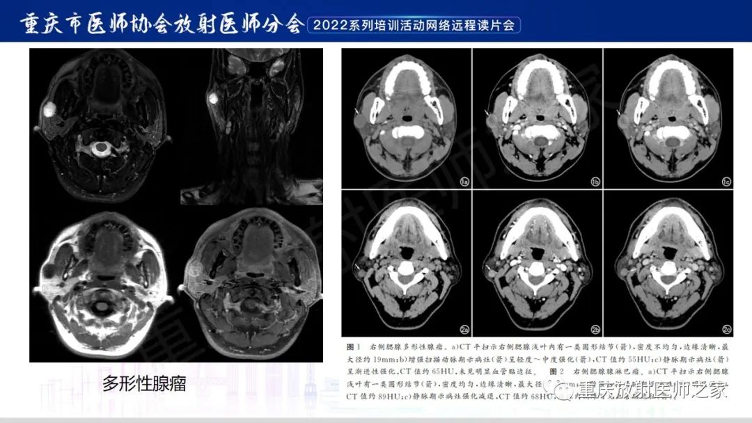 影像PPT - 【病例】腮腺腺淋巴瘤1例CT影像-15