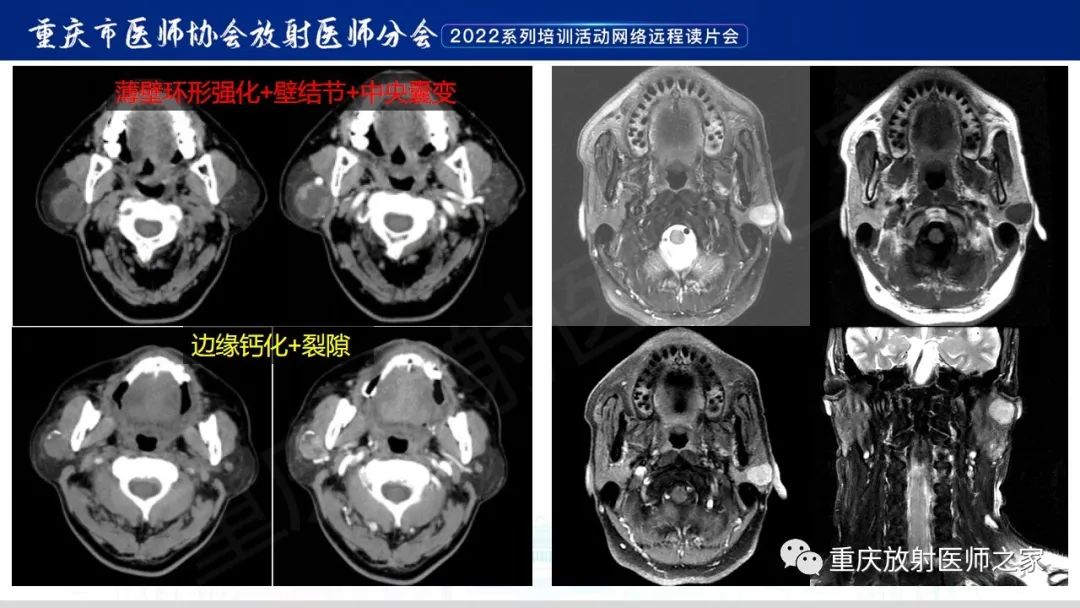 影像PPT - 【病例】腮腺腺淋巴瘤1例CT影像-17