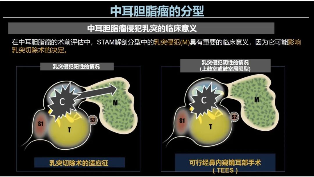 影像PPT - 【PPT】影像学方法术前预测中耳胆脂瘤的乳突侵犯-14