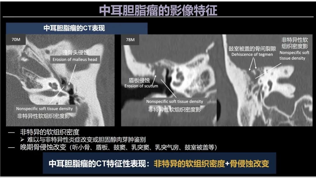 影像PPT - 【PPT】影像学方法术前预测中耳胆脂瘤的乳突侵犯-18