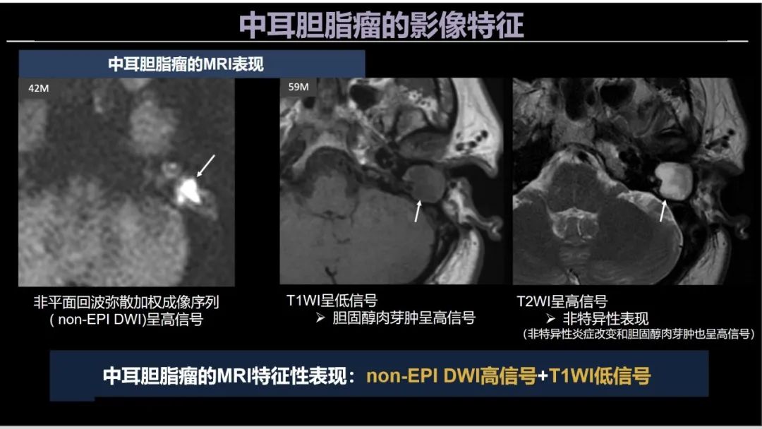 影像PPT - 【PPT】影像学方法术前预测中耳胆脂瘤的乳突侵犯-20