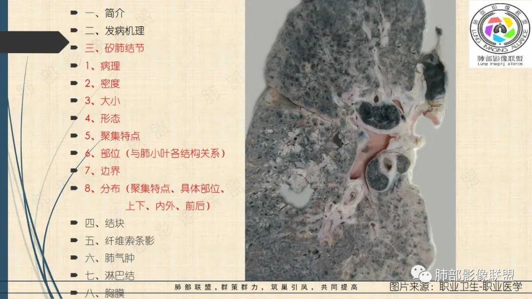 影像PPT - 【PPT】矽肺CT特点-7 影像PPT - 【PPT】矽肺CT特点-7
