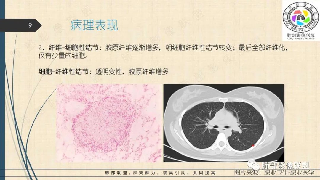 影像PPT - 【PPT】矽肺CT特点-9 影像PPT - 【PPT】矽肺CT特点-9