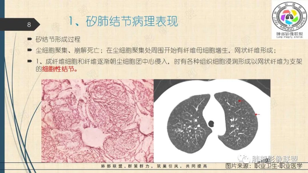 影像PPT - 【PPT】矽肺CT特点-8 影像PPT - 【PPT】矽肺CT特点-8