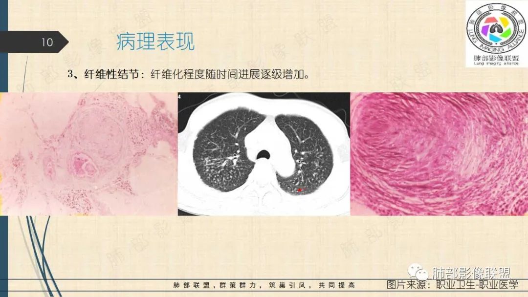 影像PPT - 【PPT】矽肺CT特点-10 影像PPT - 【PPT】矽肺CT特点-10