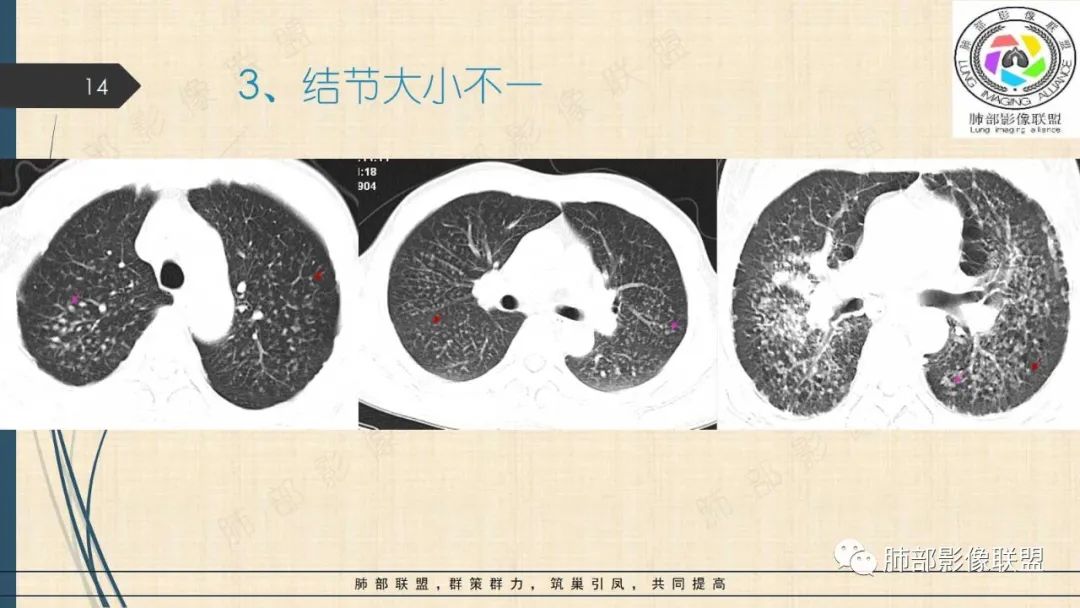 影像PPT - 【PPT】矽肺CT特点-14 影像PPT - 【PPT】矽肺CT特点-14