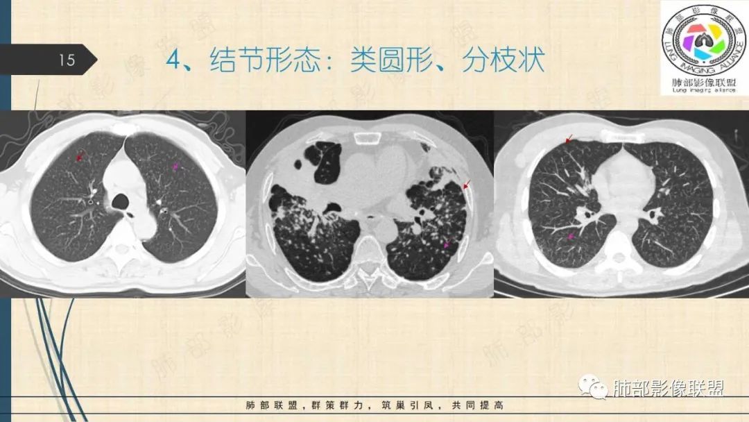影像PPT - 【PPT】矽肺CT特点-15 影像PPT - 【PPT】矽肺CT特点-15