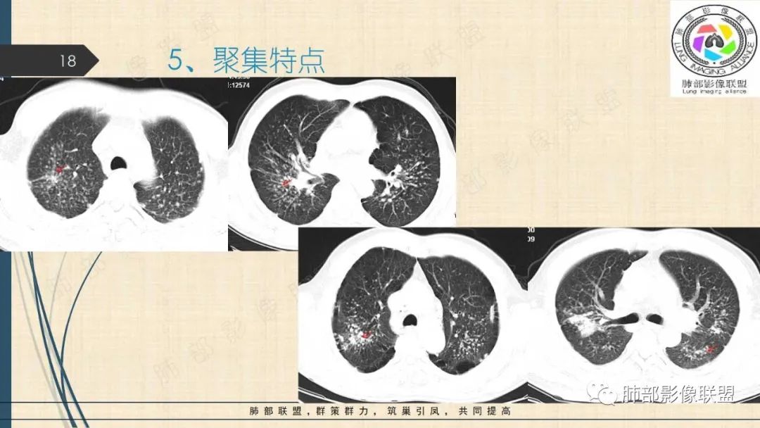 影像PPT - 【PPT】矽肺CT特点-18 影像PPT - 【PPT】矽肺CT特点-18