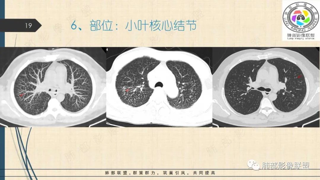 影像PPT - 【PPT】矽肺CT特点-19 影像PPT - 【PPT】矽肺CT特点-19