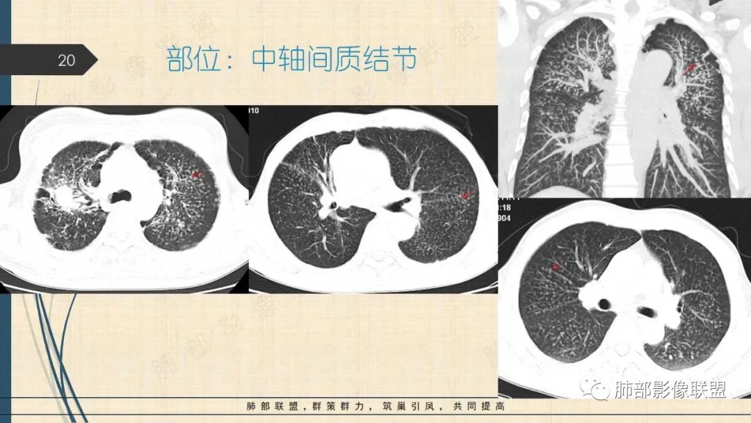 影像PPT - 【PPT】矽肺CT特点-20 影像PPT - 【PPT】矽肺CT特点-20