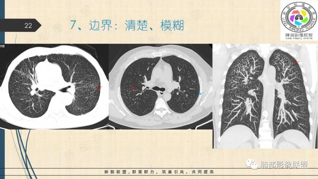 影像PPT - 【PPT】矽肺CT特点-22 影像PPT - 【PPT】矽肺CT特点-22