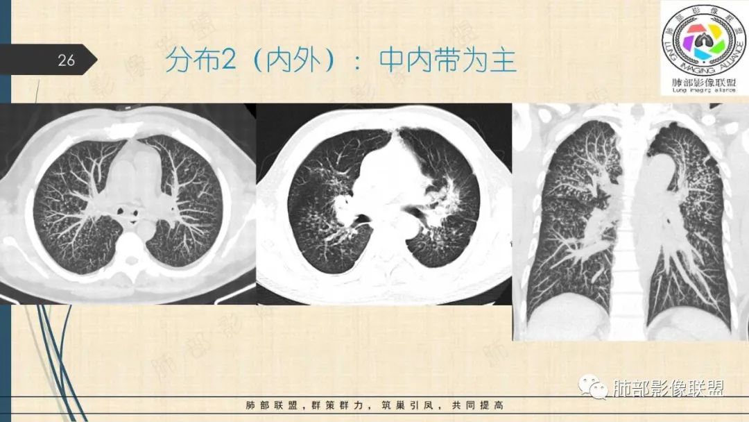 影像PPT - 【PPT】矽肺CT特点-26 影像PPT - 【PPT】矽肺CT特点-26
