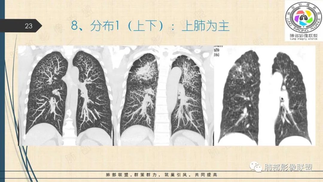 影像PPT - 【PPT】矽肺CT特点-23 影像PPT - 【PPT】矽肺CT特点-23
