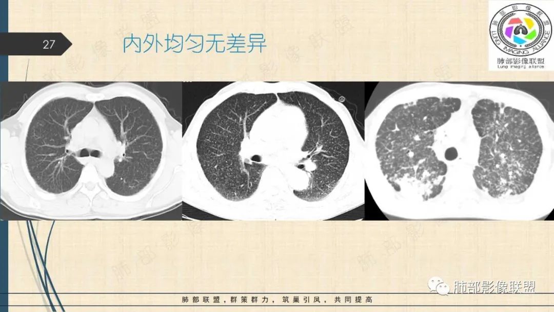 影像PPT - 【PPT】矽肺CT特点-27 影像PPT - 【PPT】矽肺CT特点-27