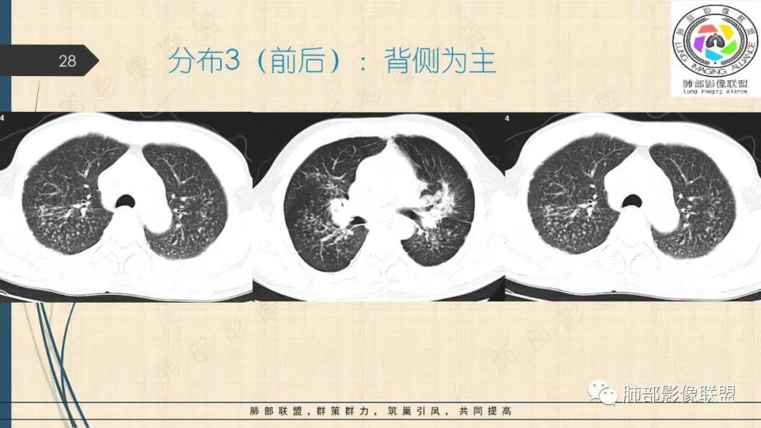 影像PPT - 【PPT】矽肺CT特点-28 影像PPT - 【PPT】矽肺CT特点-28