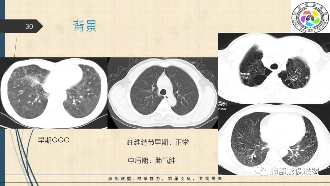 影像PPT - 【PPT】矽肺CT特点-30 影像PPT - 【PPT】矽肺CT特点-30