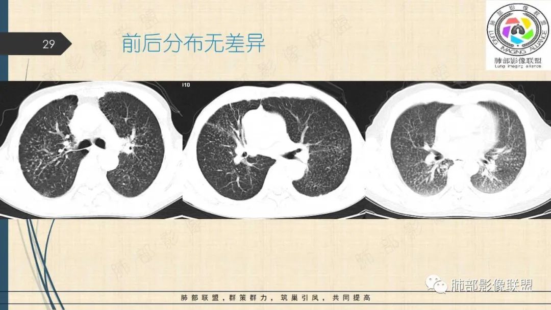 影像PPT - 【PPT】矽肺CT特点-29 影像PPT - 【PPT】矽肺CT特点-29