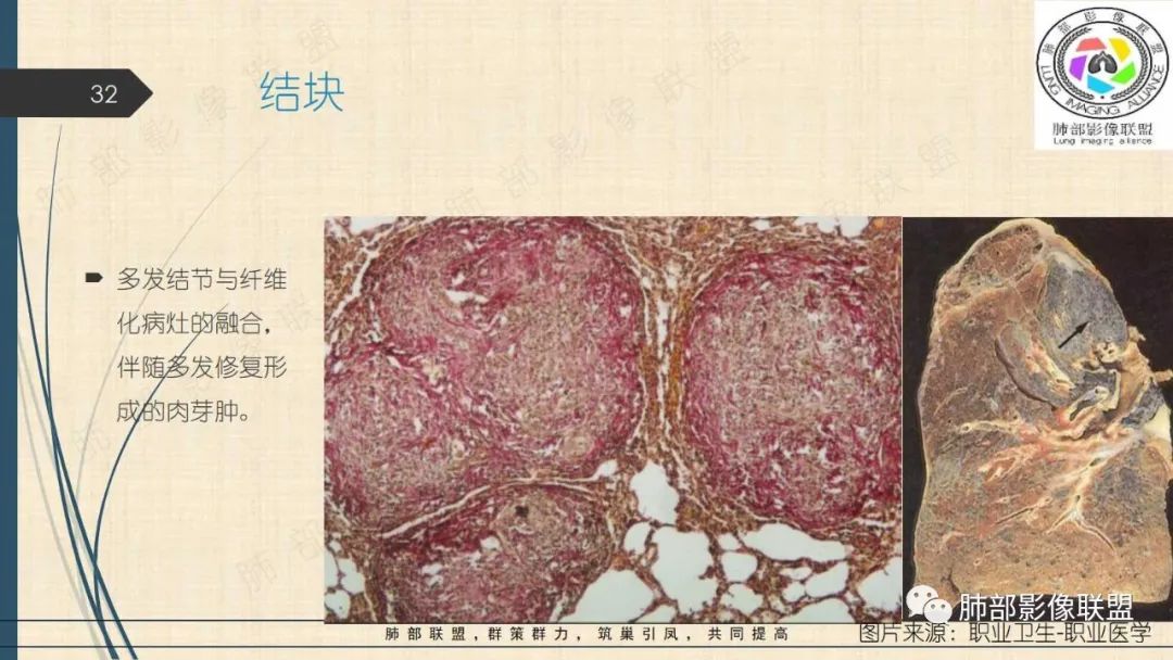 影像PPT - 【PPT】矽肺CT特点-32 影像PPT - 【PPT】矽肺CT特点-32