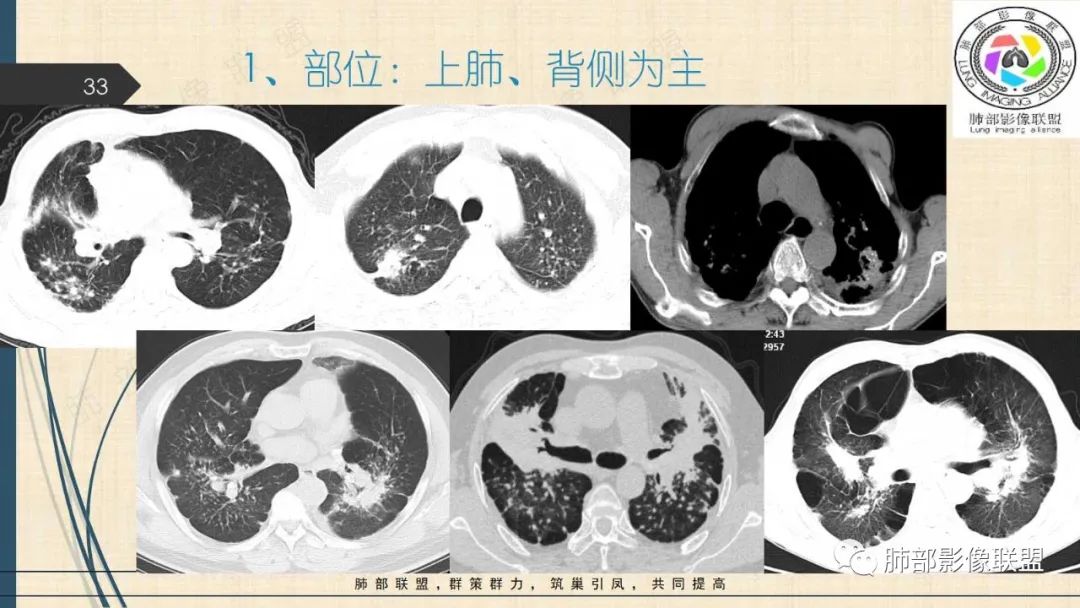 影像PPT - 【PPT】矽肺CT特点-33 影像PPT - 【PPT】矽肺CT特点-33