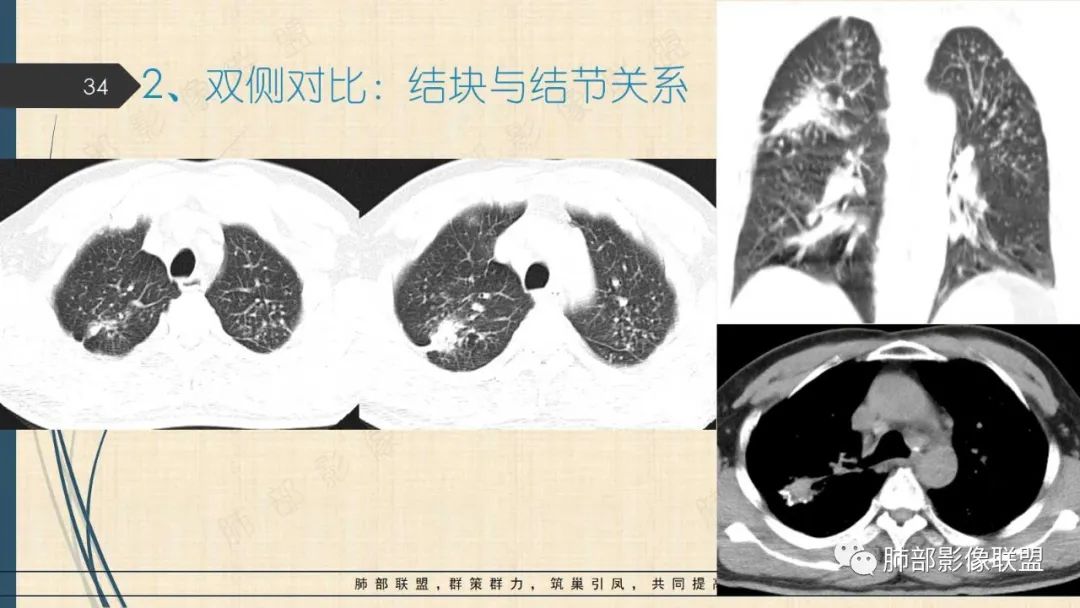 影像PPT - 【PPT】矽肺CT特点-34 影像PPT - 【PPT】矽肺CT特点-34
