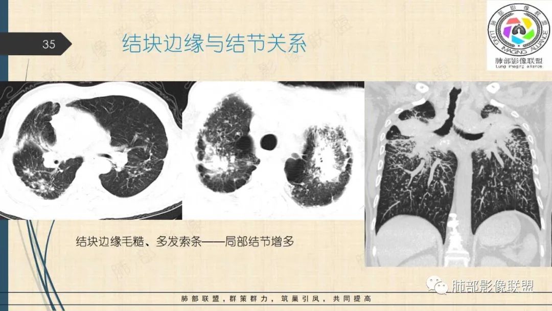 影像PPT - 【PPT】矽肺CT特点-35 影像PPT - 【PPT】矽肺CT特点-35