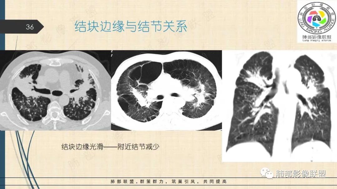 影像PPT - 【PPT】矽肺CT特点-36 影像PPT - 【PPT】矽肺CT特点-36