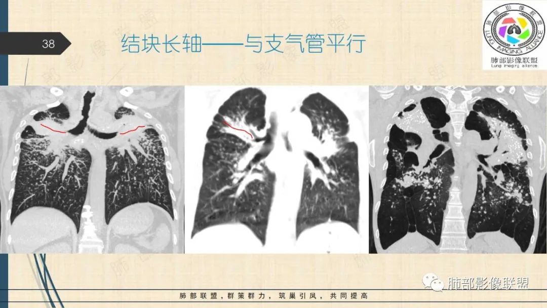 影像PPT - 【PPT】矽肺CT特点-38 影像PPT - 【PPT】矽肺CT特点-38