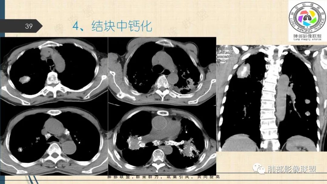 影像PPT - 【PPT】矽肺CT特点-39 影像PPT - 【PPT】矽肺CT特点-39
