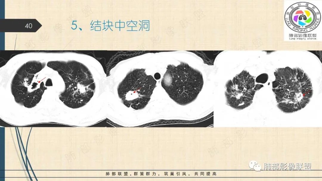 影像PPT - 【PPT】矽肺CT特点-40 影像PPT - 【PPT】矽肺CT特点-40