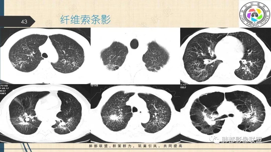 影像PPT - 【PPT】矽肺CT特点-43 影像PPT - 【PPT】矽肺CT特点-43
