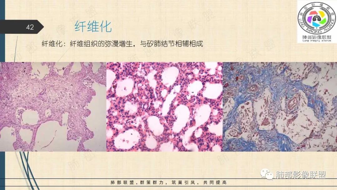 影像PPT - 【PPT】矽肺CT特点-42 影像PPT - 【PPT】矽肺CT特点-42