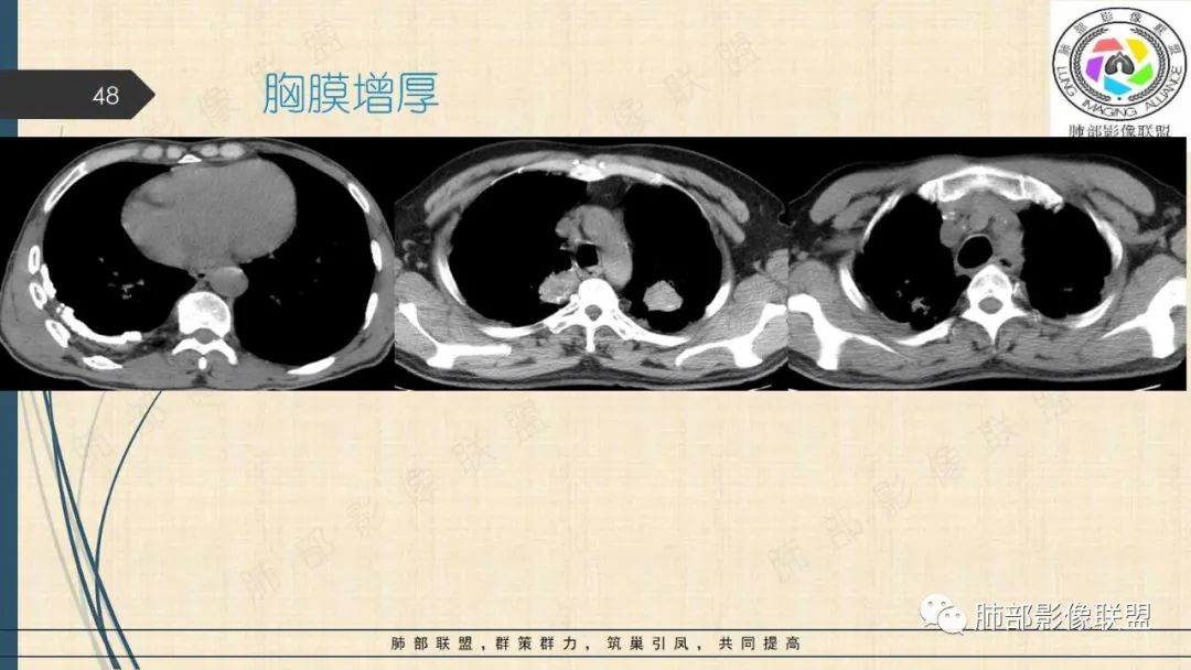 影像PPT - 【PPT】矽肺CT特点-48 影像PPT - 【PPT】矽肺CT特点-48