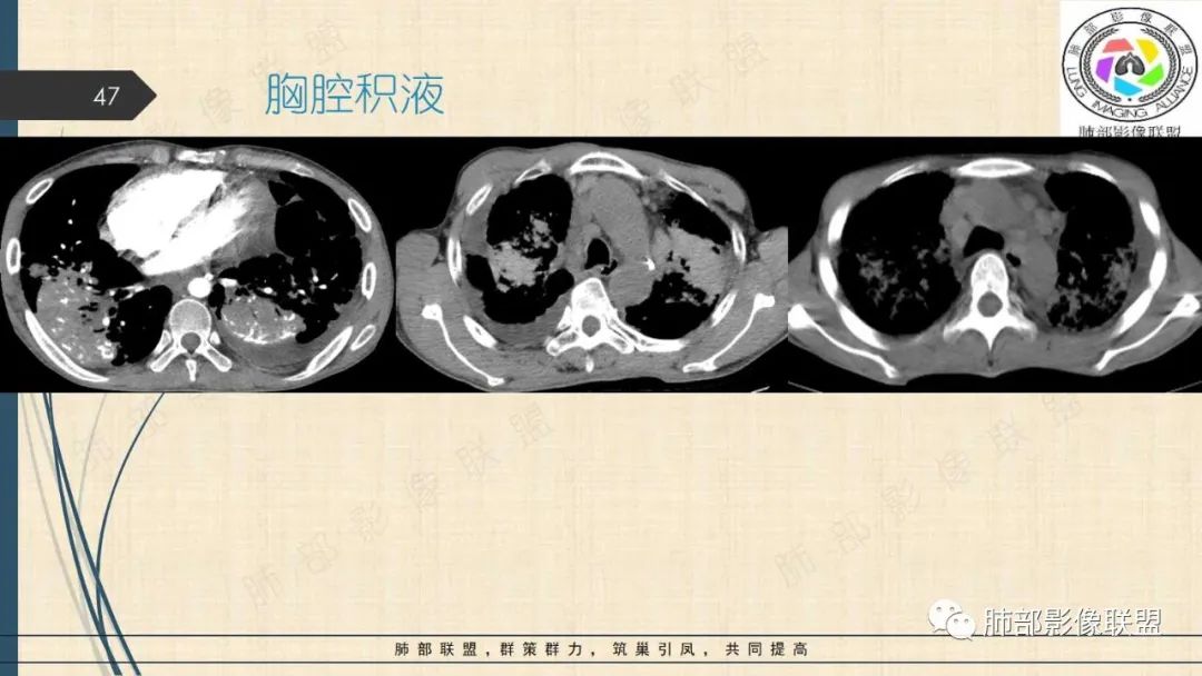 影像PPT - 【PPT】矽肺CT特点-47 影像PPT - 【PPT】矽肺CT特点-47