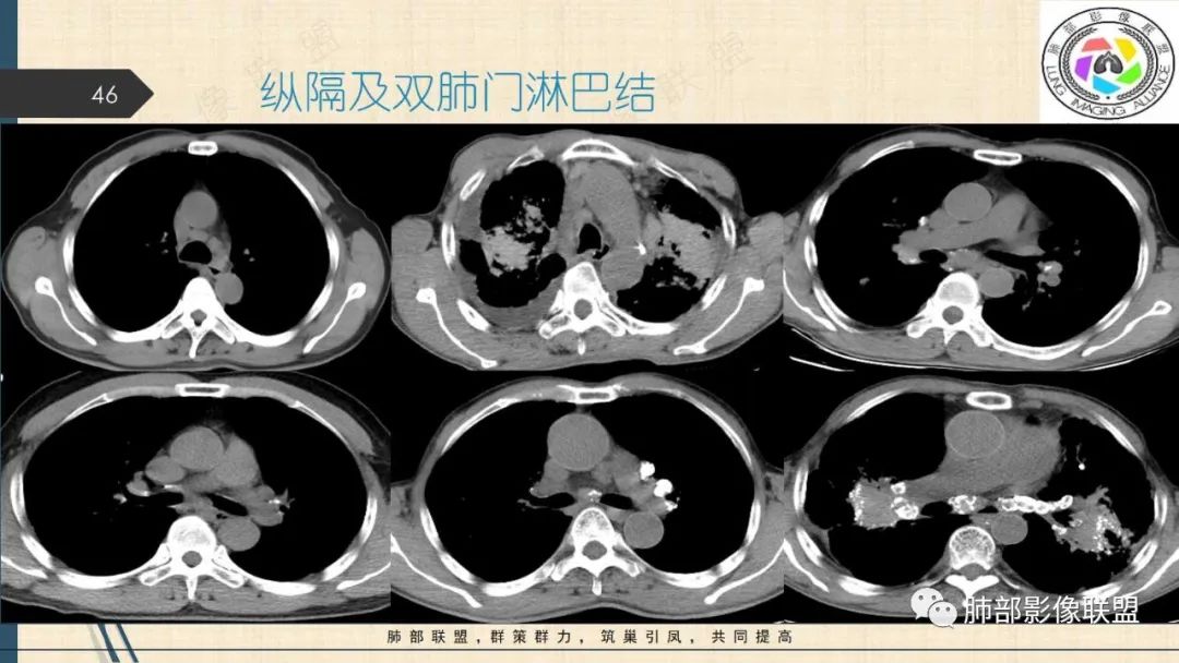 影像PPT - 【PPT】矽肺CT特点-46 影像PPT - 【PPT】矽肺CT特点-46