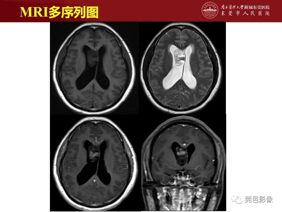 影像PPT - 【病例】室管膜下星形细胞瘤1例CT及MR-12