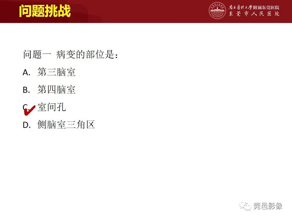 影像PPT - 【病例】室管膜下星形细胞瘤1例CT及MR-18