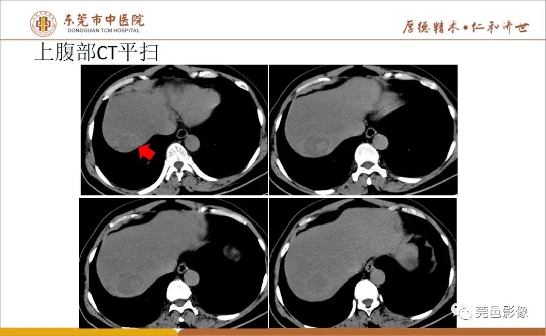 影像PPT - 【病例】肝脏非典型血管瘤1例CT及MR-8