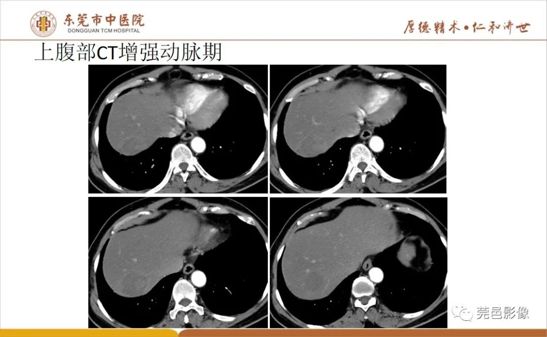 影像PPT - 【病例】肝脏非典型血管瘤1例CT及MR-9