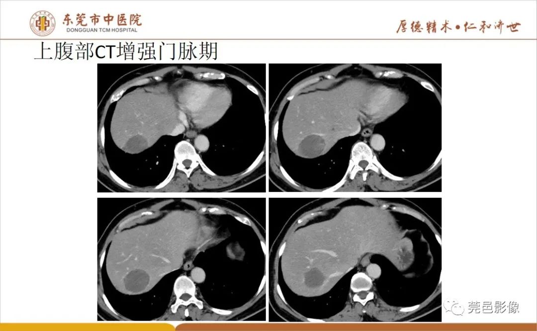 影像PPT - 【病例】肝脏非典型血管瘤1例CT及MR-10